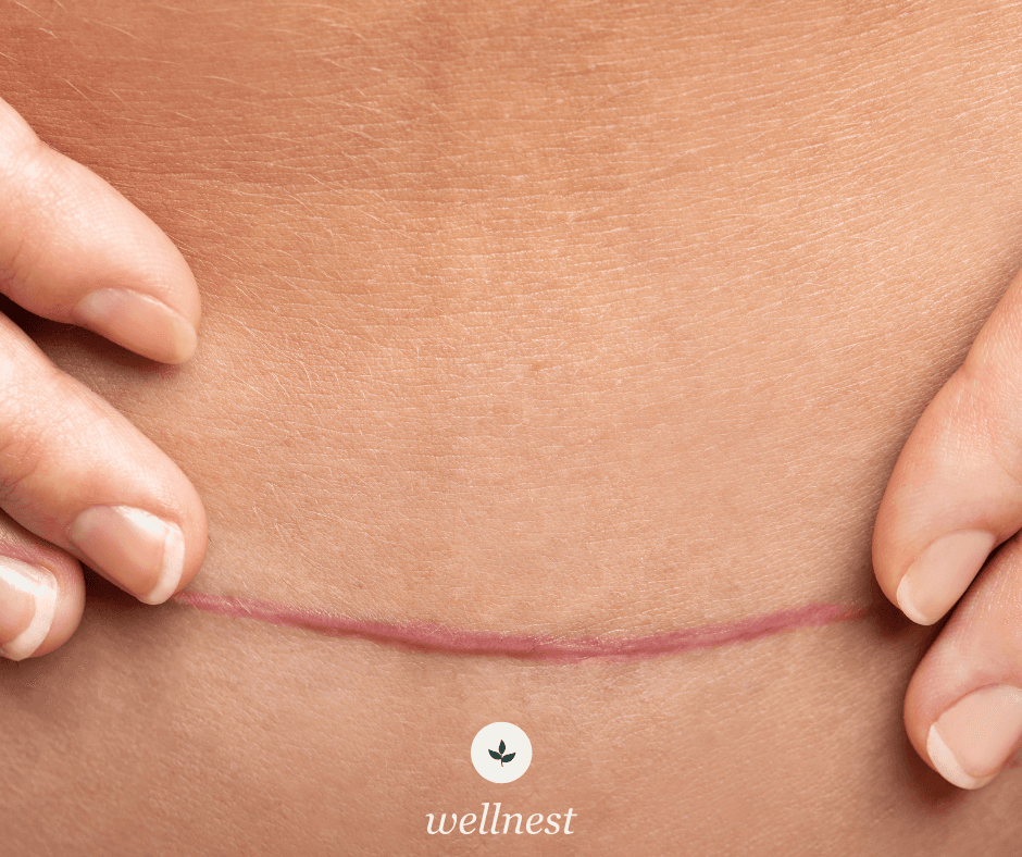 Caring for Scars After Surgery