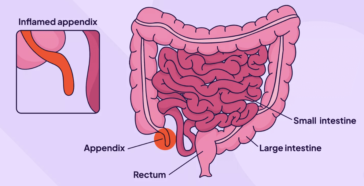 Why August Matters: Shining a Light on Appendix Cancer Awareness Month
